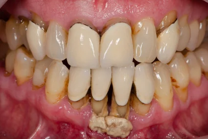 GumDisease2