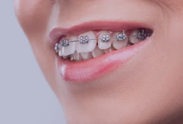 Orthodontic-Treatment