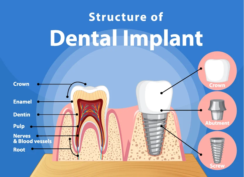 dental-implan