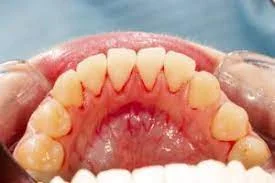 gum-disease3